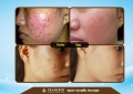 Điều trị mụn dứt điểm bằng ánh sáng New Elight -Thẩm Mỹ Diamond