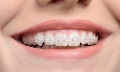 Niềng răng mất bao lâu thời gian thì hiệu quả?