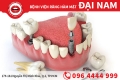 Trồng răng Implant - Giải pháp phục hình răng tối ưu nhất
