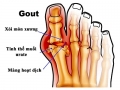 Tìm hiểu về bệnh gout thứ phát