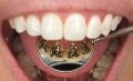 Các hình thức nắn chỉnh răng hiệu quả