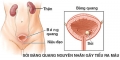 chữa bênh tiểu ra máu do viêm niệu đạo bằng cách nào ?