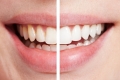 Đi tẩy trắng răng có đau không?