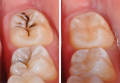 Hàn răng có đau không? Nha sĩ tư vấn