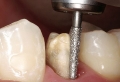 Chuyên mục giải đáp: Có nên bọc răng sứ không?